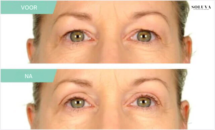 LiftStrips - Onzichtbare Ooglifting