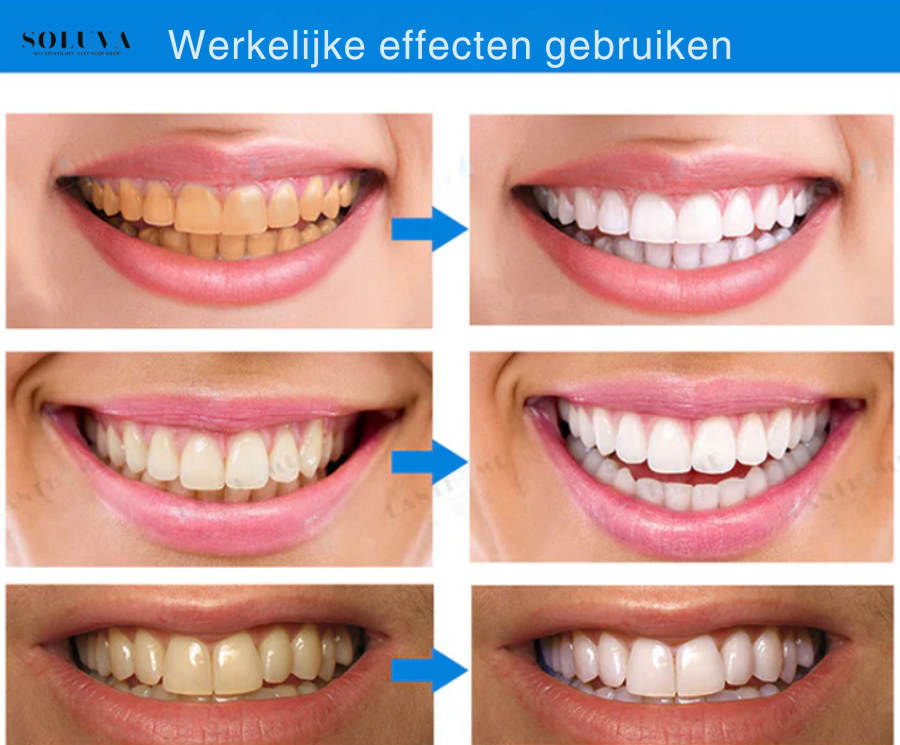 Teeth Essence - Ultra Sterke Tandenbleker - 1+2 Gratis!