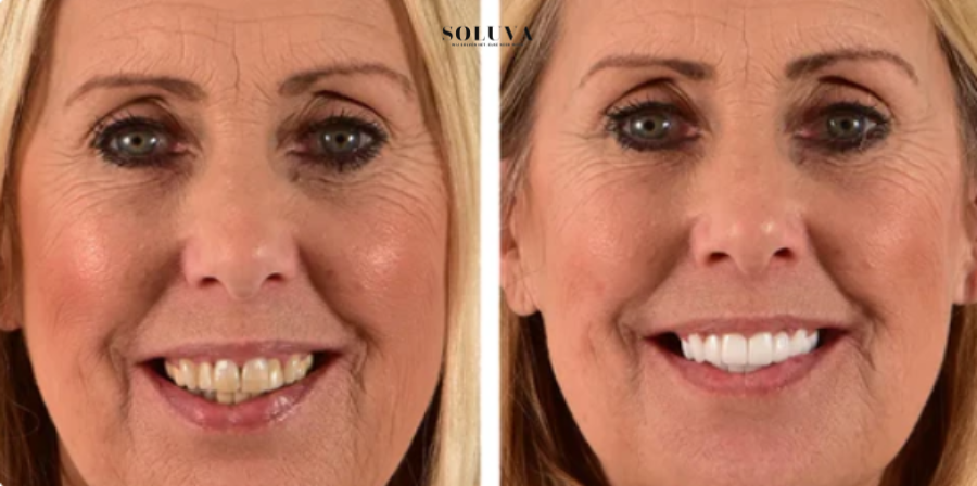 Teeth Essence - Ultra Sterke Tandenbleker - 1+2 Gratis!