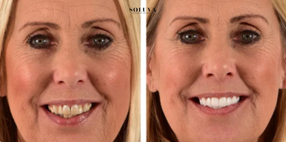 Teeth Essence - Ultra Sterke Tandenbleker - 1+2 Gratis!