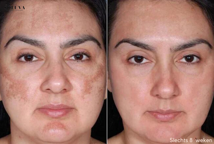 SkinShine - Huidverhelderende Gezichtsserum - 1+1 Gratis!