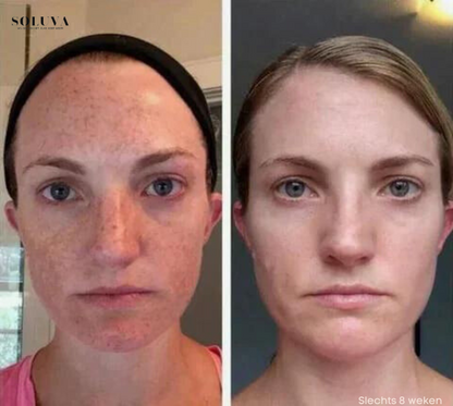 SkinShine - Huidverhelderende Gezichtsserum - 1+1 Gratis!