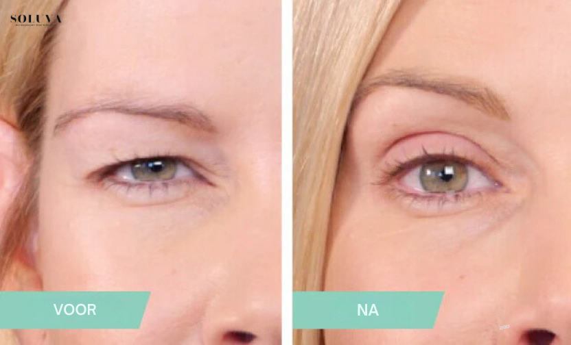 LiftStrips - Onzichtbare Ooglifting