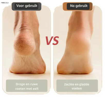 SmoothFoot - Oplaadbare Eeltverwijderaar